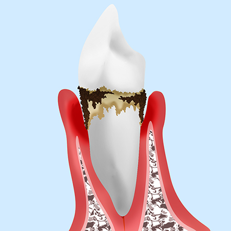 中度の歯周炎⇒歯周外科治療