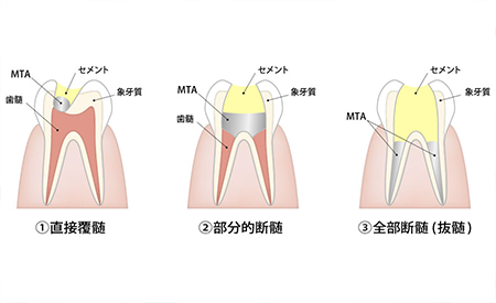 歯髄温存療法について