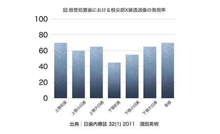 根管治療の成功率は欧米だと90%くらいですが、日本では６０%程度と言われています。