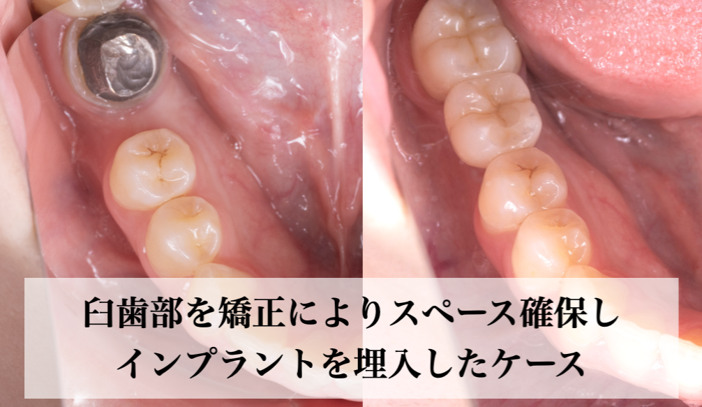 1927前歯3本をセラミック治療で綺麗にした症例