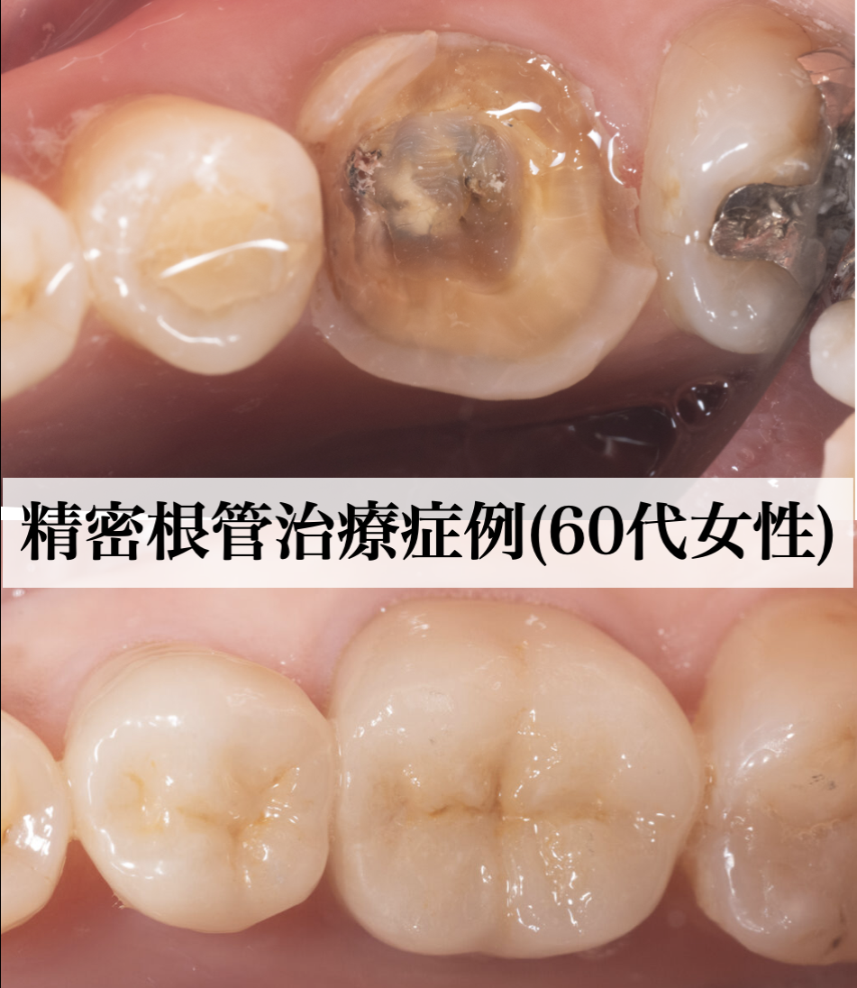 【精密根管治療】60代女性　主訴：他院にて根管治療を行ったが、治らないと言われた