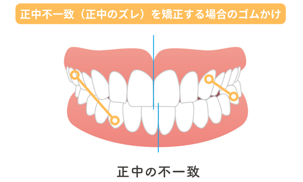 正中不一致（正中のズレ）を矯正する場合のゴムかけ