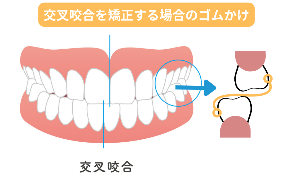 交叉咬合を矯正する場合のゴムかけ