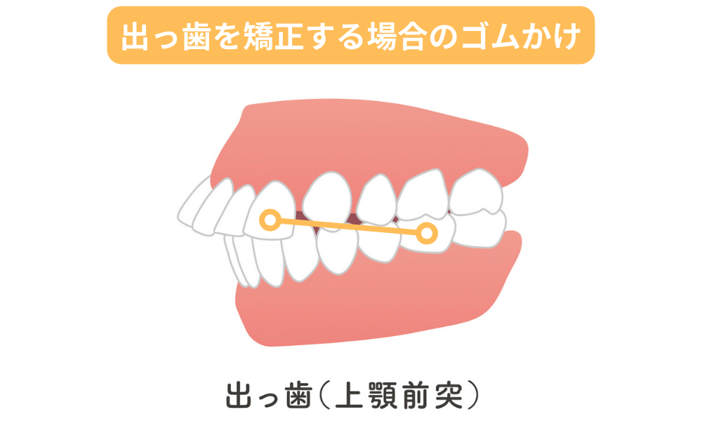 上顎前突（出っ歯）を矯正する場合のゴムかけ