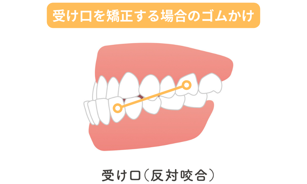 下顎前突（受け口）を矯正する場合のゴムかけ